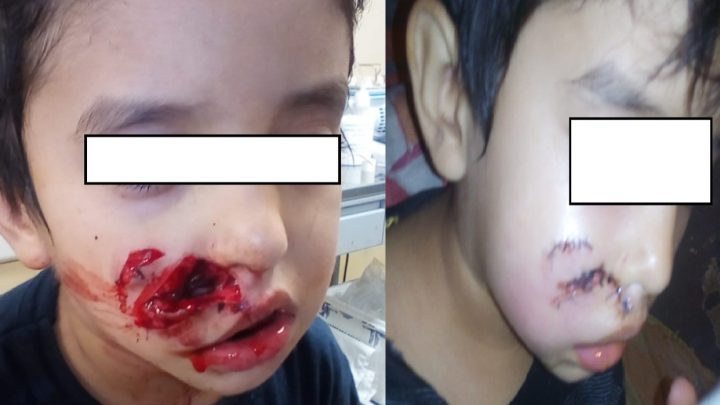 Perro suelto mordió a un niño pequeño en Río Grande