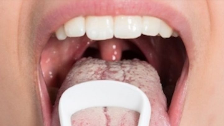 «Sapito», Le Enfermedad De Transmisión Sexual Que Te Deja La Lengua Blanca: ¿Cómo Se Contagia?