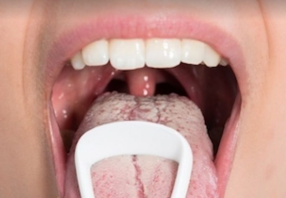 «Sapito», Le Enfermedad De Transmisión Sexual Que Te Deja La Lengua Blanca: ¿Cómo Se Contagia?