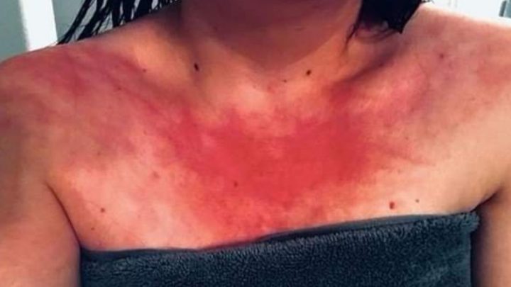 La agotadora vida de una mujer alérgica al agua: hasta toma analgésicos antes de bañarse