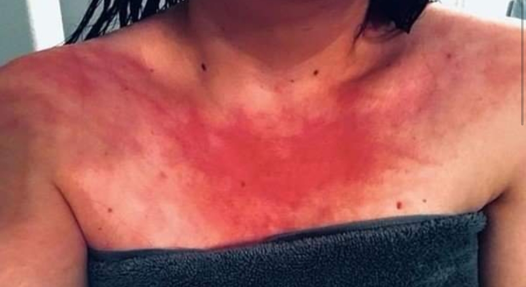 La agotadora vida de una mujer alérgica al agua: hasta toma analgésicos antes de bañarse La agotadora vida de una mujer alérgica al agua: hasta toma analgésicos antes de bañarse
