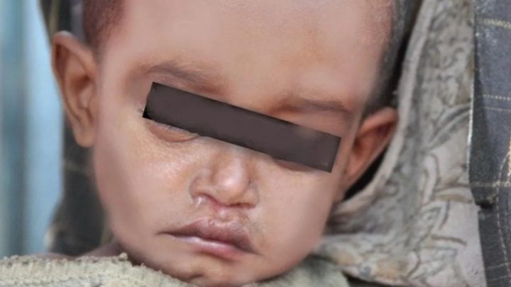 Bebé con quemaduras y mordidas fue internado de urgencia: detienen a su madre y a su padrastro