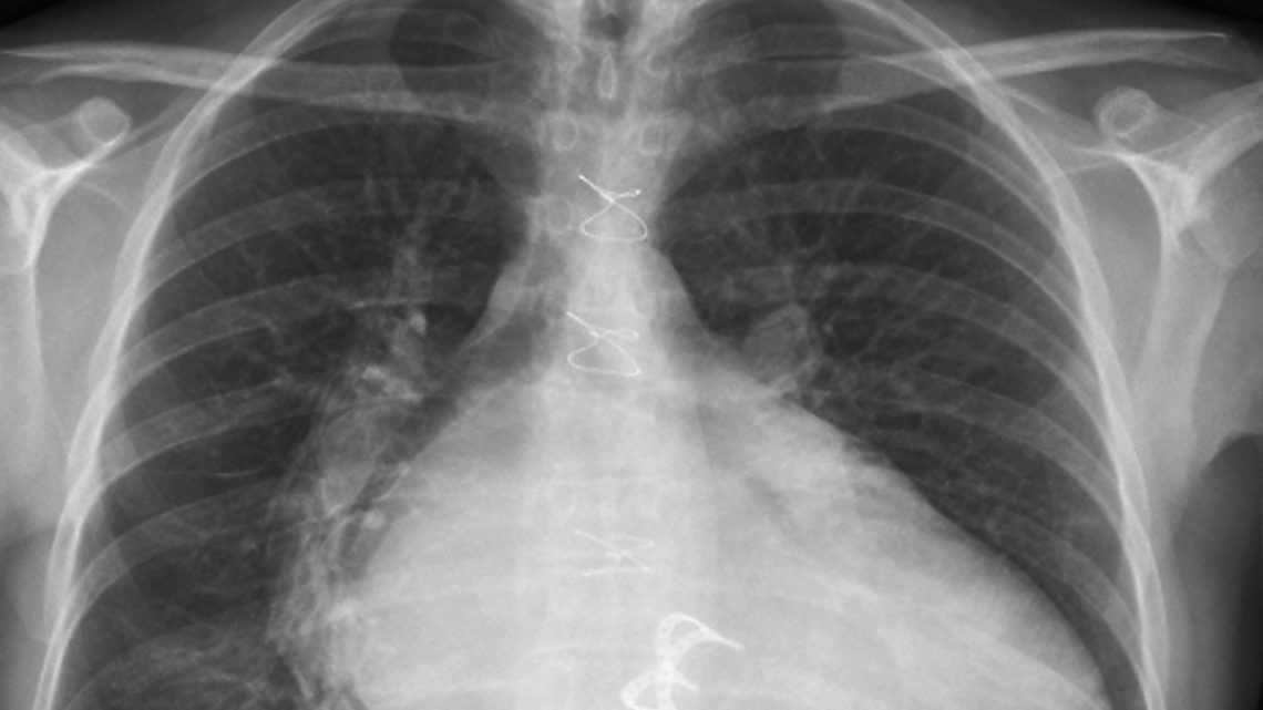 Creyeron que tenia un tumor, pero eran gasas olvidadas de una antigua operación Creyeron que tenia un tumor, pero eran gasas olvidadas de una antigua operación