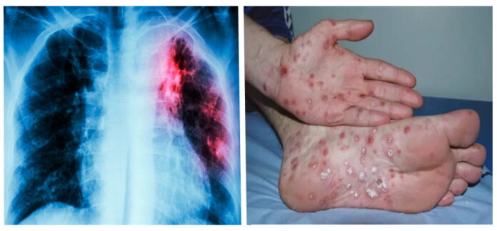 Tuberculosis y sífilis, dos pandemias que volvieron a la Argentina