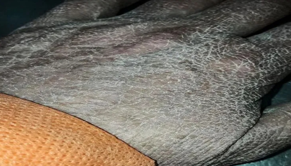Santa Fe: Así quedó la mano de una enfermera luego de largas horas de trabajo por la pandemia Santa Fe: Así quedó la mano de una enfermera luego de largas horas de trabajo por la pandemia