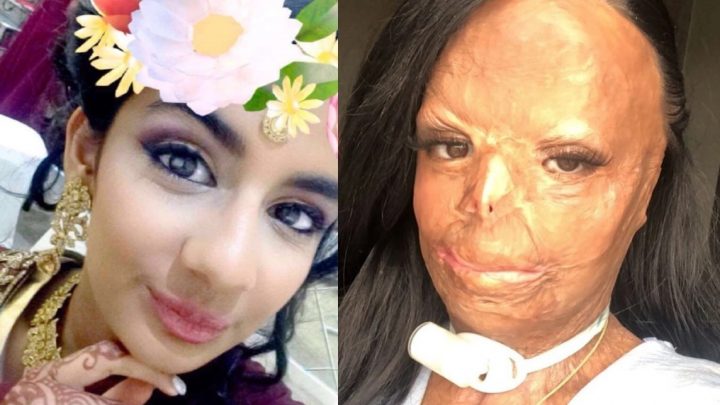 Sufrió quemaduras en el 55% de su cuerpo y asegura que ahora es mejor persona: “Soy mucho más fuerte”