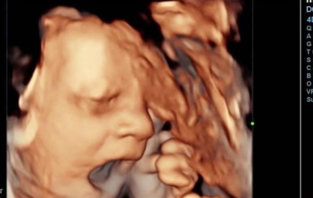 Hicieron una ecografía para ver a su bebé y los sorprendió un gesto que hizo “como si dijera ‘ déjame en paz’”