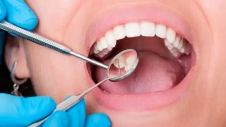 Caída de dientes: posible nueva secuela del Covid-19