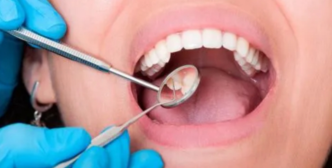 Caída de dientes: posible nueva secuela del Covid-19 Caída de dientes: posible nueva secuela del Covid-19