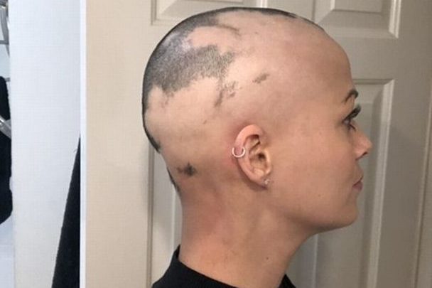 Perdió todo su pelo después de usar una bobina anticonceptiva