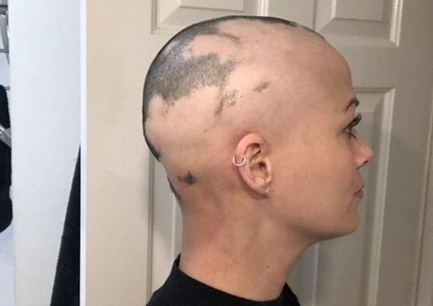 Perdió todo su pelo después de usar una bobina anticonceptiva