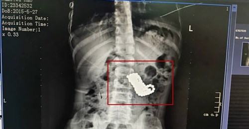 Un nene se comió más de 100 bolitas magnéticas mientras miraba televisión