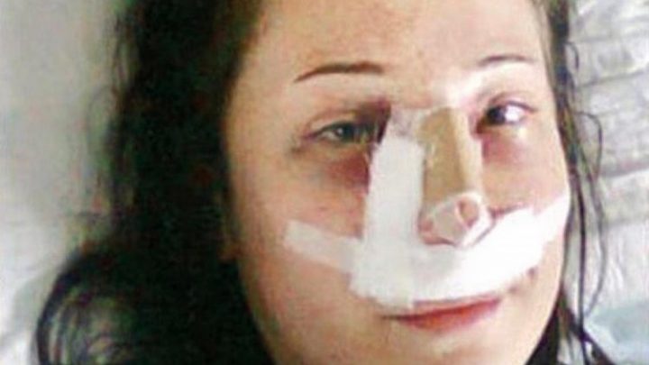 Fue a un hospital a operarse la nariz y le amputaron las dos piernas por un error