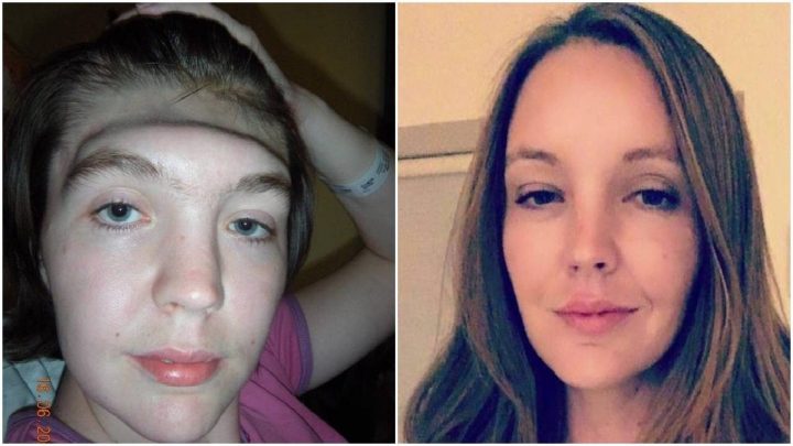 Perdió su frente por llevar los pies en la guantera del auto durante un choque