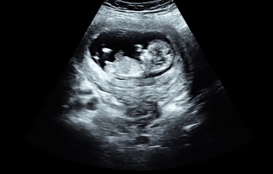 Piden que las mujeres vean una ecografía del bebé antes de hacerse un aborto