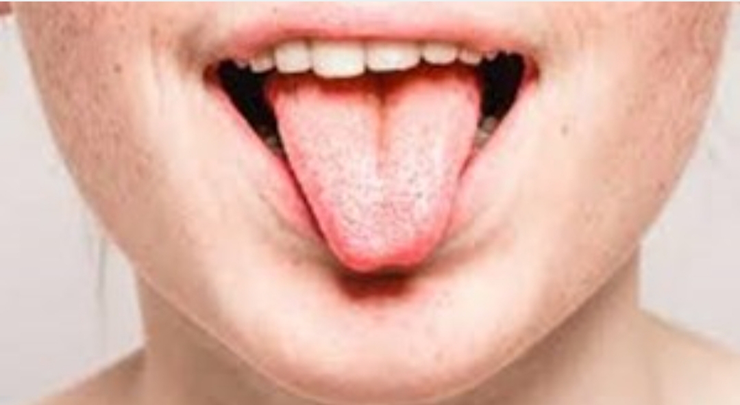 «Lengua covid»: alertan sobre un nuevo síntoma del coronavirus «Lengua covid»: alertan sobre un nuevo síntoma del coronavirus