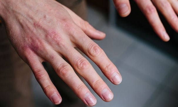 Coronavirus: un estudio asegura que las lesiones en la lengua y manchas en los pies son síntomas de la enfermedad