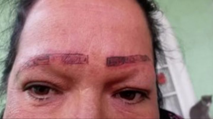 Una mujer se fue a tatuar las cejas y terminó con cicatrices y quemaduras en la cara