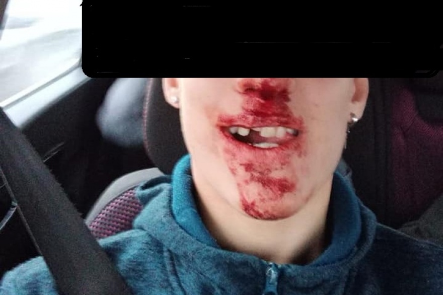 Confirman la denuncia del menor que perdió los dientes por una golpiza recibida por 3 jóvenes Confirman la denuncia del menor que perdió los dientes por una golpiza recibida por 3 jóvenes