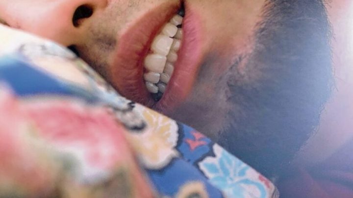 Bruxismo.  Otra consecuencia del estrés