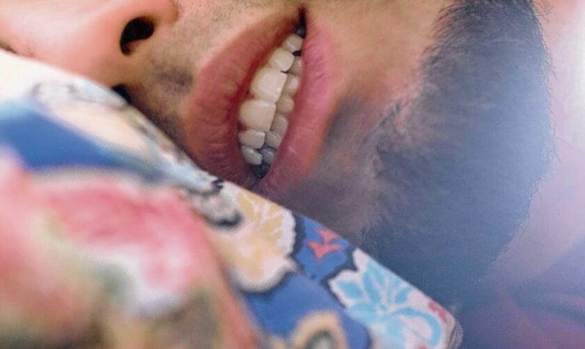 Bruxismo.  Otra consecuencia del estrés