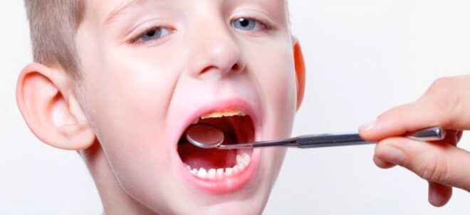 Tengo una caries… ¿y ahora?