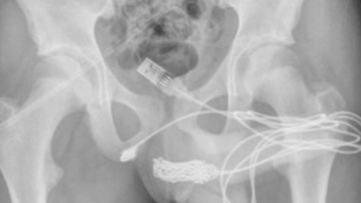 Un Chico Intentaba Medir Su Pene Y Se Le Enredó Un Cable USB En La Uretra: Tuvieron Que Operarlo
