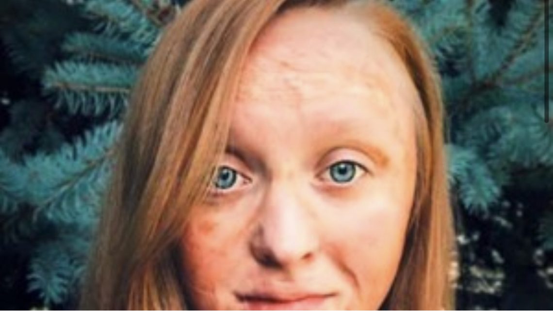 Su mamá intentó sacarle los piojos con nafta, se prendió fuego y estuvo a punto de morir quemada Su mamá intentó sacarle los piojos con nafta, se prendió fuego y estuvo a punto de morir quemada