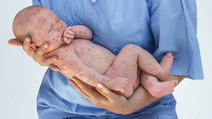 Más de 22 millones de bebés no fueron vacunados contra el sarampión en el mundo en 2020
