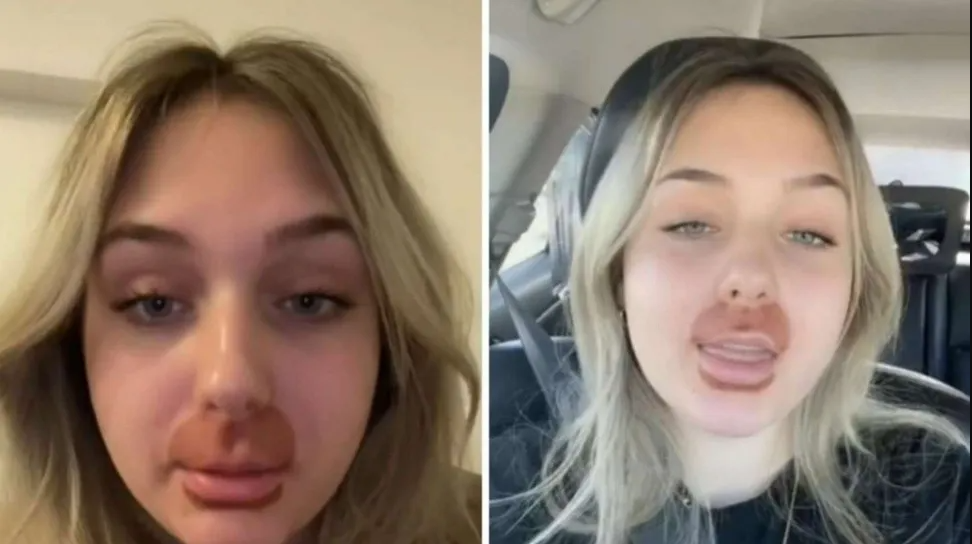 Una joven se hizo un tratamiento en los labios y ahora es comparada con un personaje de Los Simpson