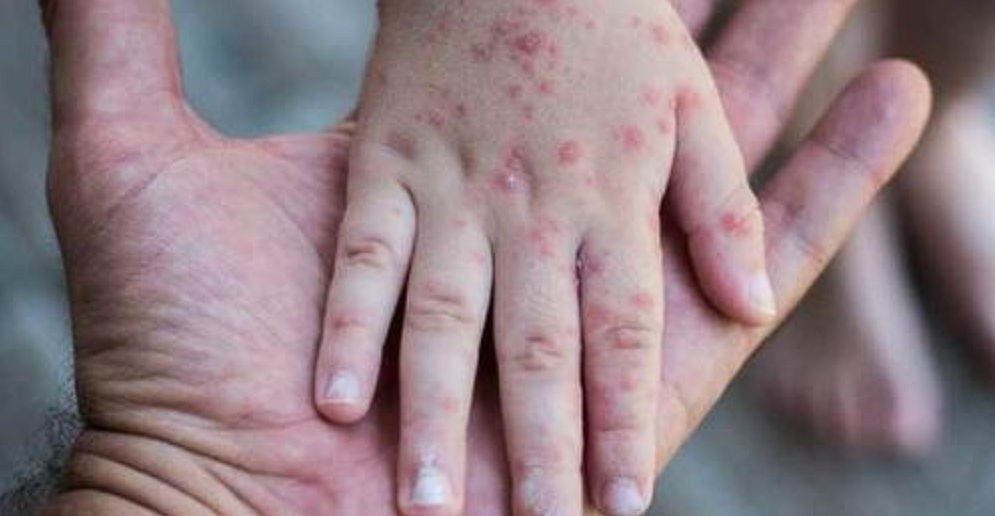 Viruela del mono: el Ministerio de Salud dio 3 recomendaciones ante el primer caso sospechoso en Argentina