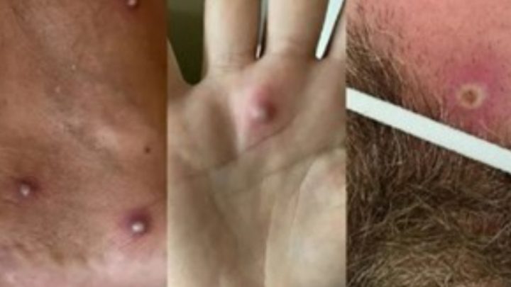 Primer caso en el mundo: fue al hospital con síntomas dio positivo de Covid, viruela del mono y VIH