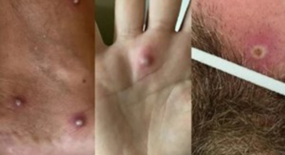 Primer caso en el mundo: fue al hospital con síntomas dio positivo de Covid, viruela del mono y VIH