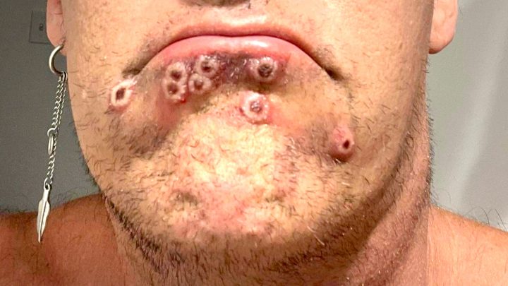 Se confirmó un caso de viruela del mono en Tierra del Fuego