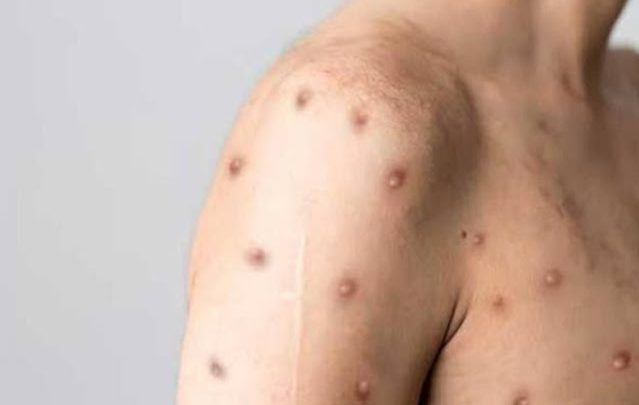 Viruela del mono, cuatro casos confirmados y cuatro sospechosos en TDF