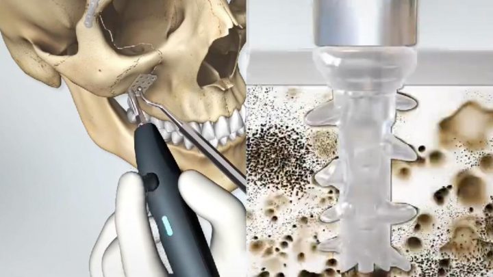 Se realizó con éxito la primera intervención maxilofacial pediátrica en el HRRG